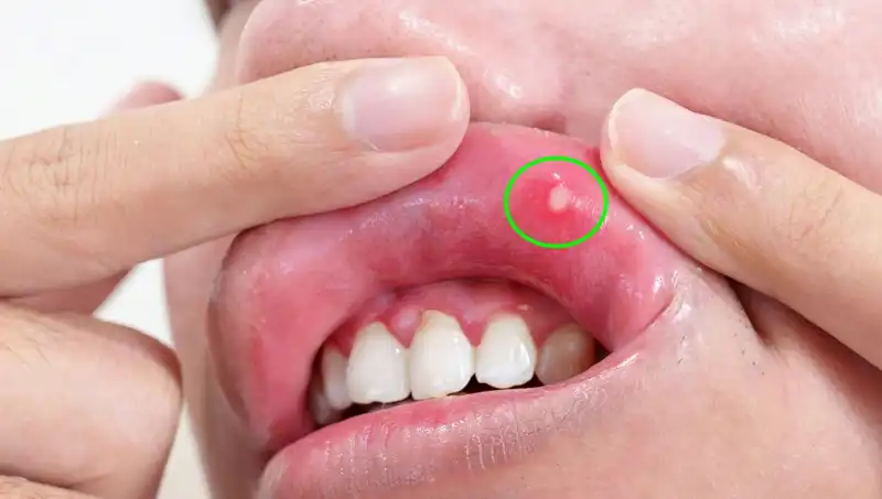 Vücut Sağlığını Tehdit Eden 5 B Vitamini Eksikliği Belirtisi