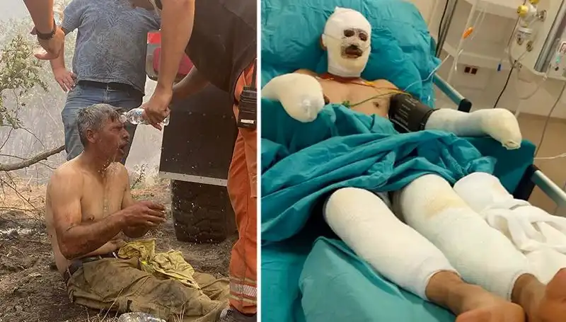 Yanıyorum Diye Feryat Eden Orman İşçisinin Hayat Mücadelesi Devam Ediyor